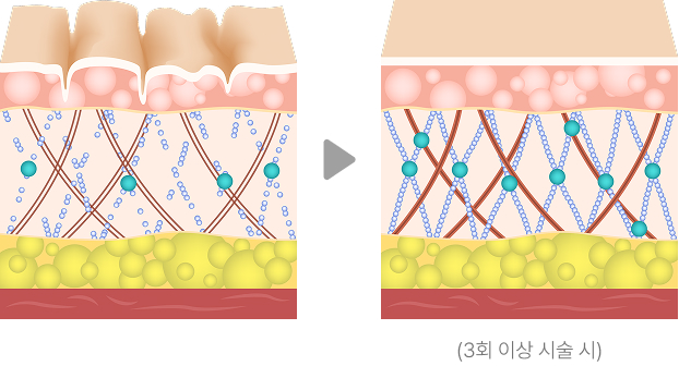 3회이상 시술시 변화