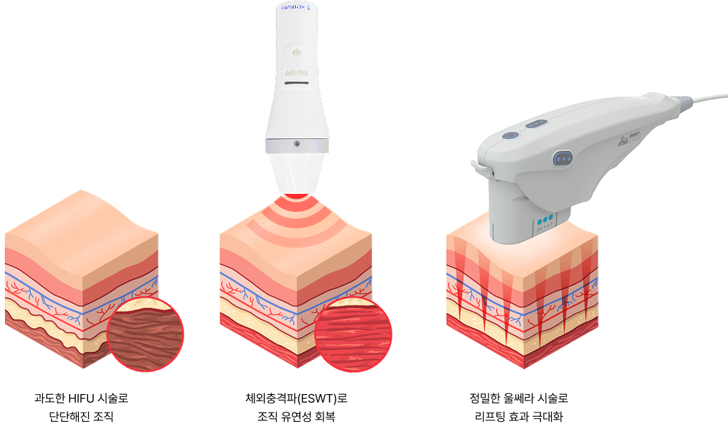 과도한 HIFU 시술로 단단해진 조직, 체외충격파(ESWT)로 조직 유연성 회복, 정밀한 울쎄라 시술로 리프팅 효과 극대화