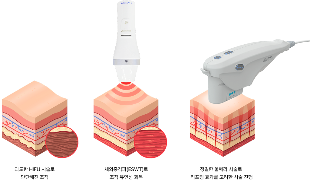 과도한 HIFU 시술로 단단해진 조직, 체외충격파(ESWT)로 조직 유연성 회복, 정밀한 울쎄라 시술로 리프팅 효과 극대화