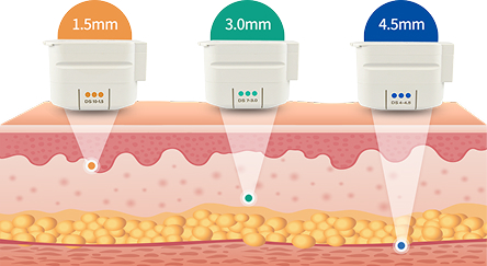 마른 얼굴, 울쎄라 예시