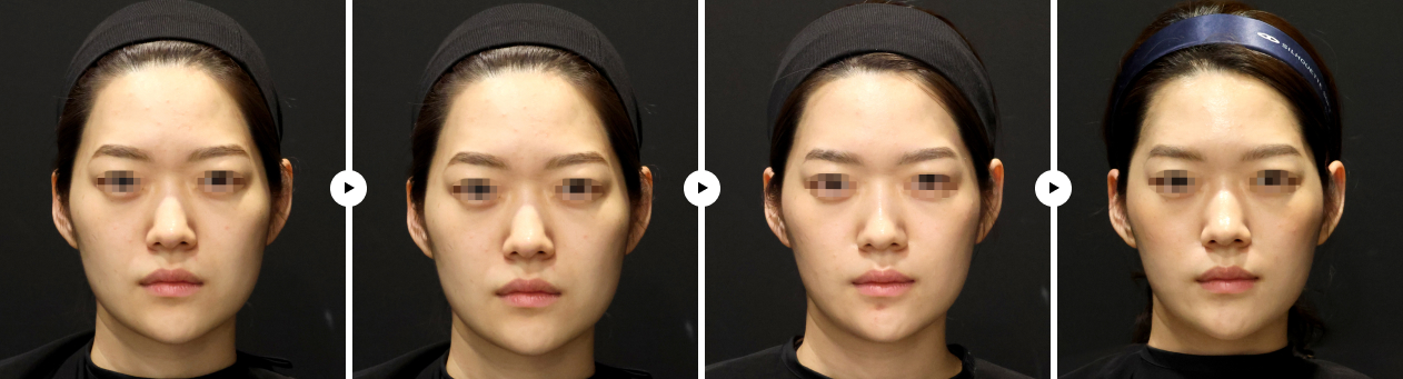 이중터 실루엣 전후사진