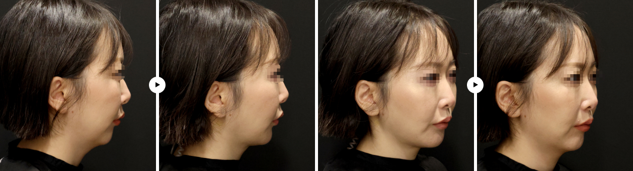 이중턱 실루엣 전후사진